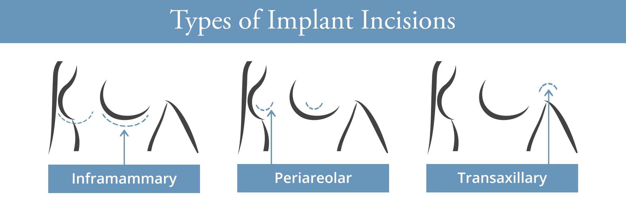 Types of Breast augmentation incisions - Cosmeticsurg