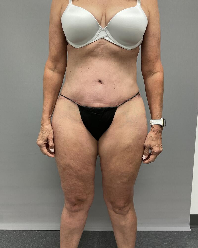 Body Lift Before & After Image