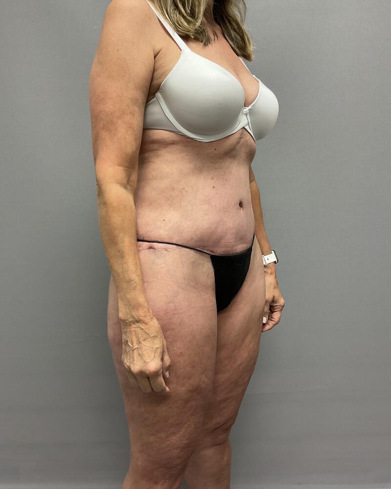 Body Lift Before & After Image