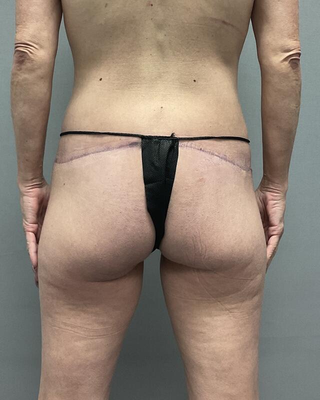 Body Lift Before & After Image