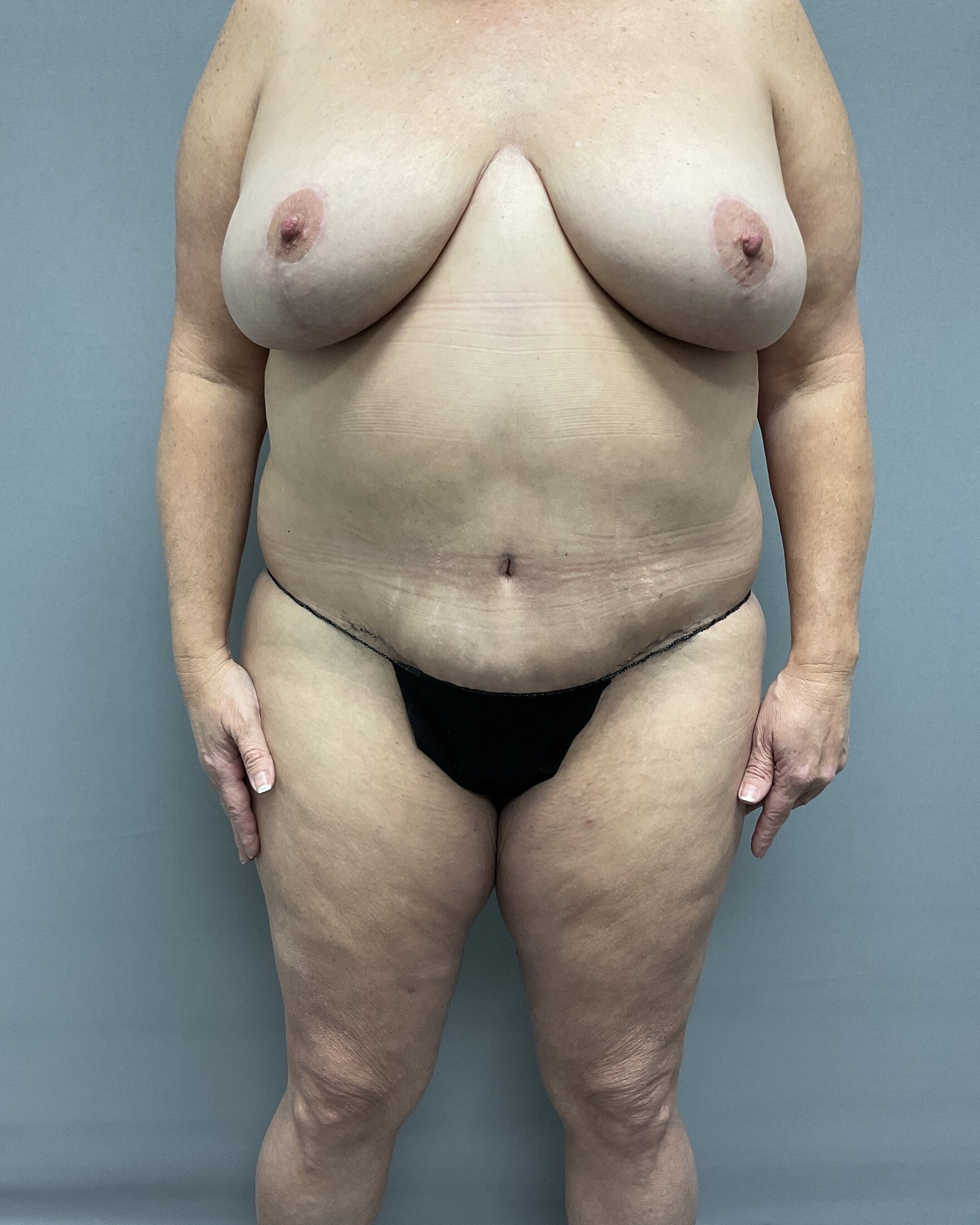 Body Lift Before & After Image