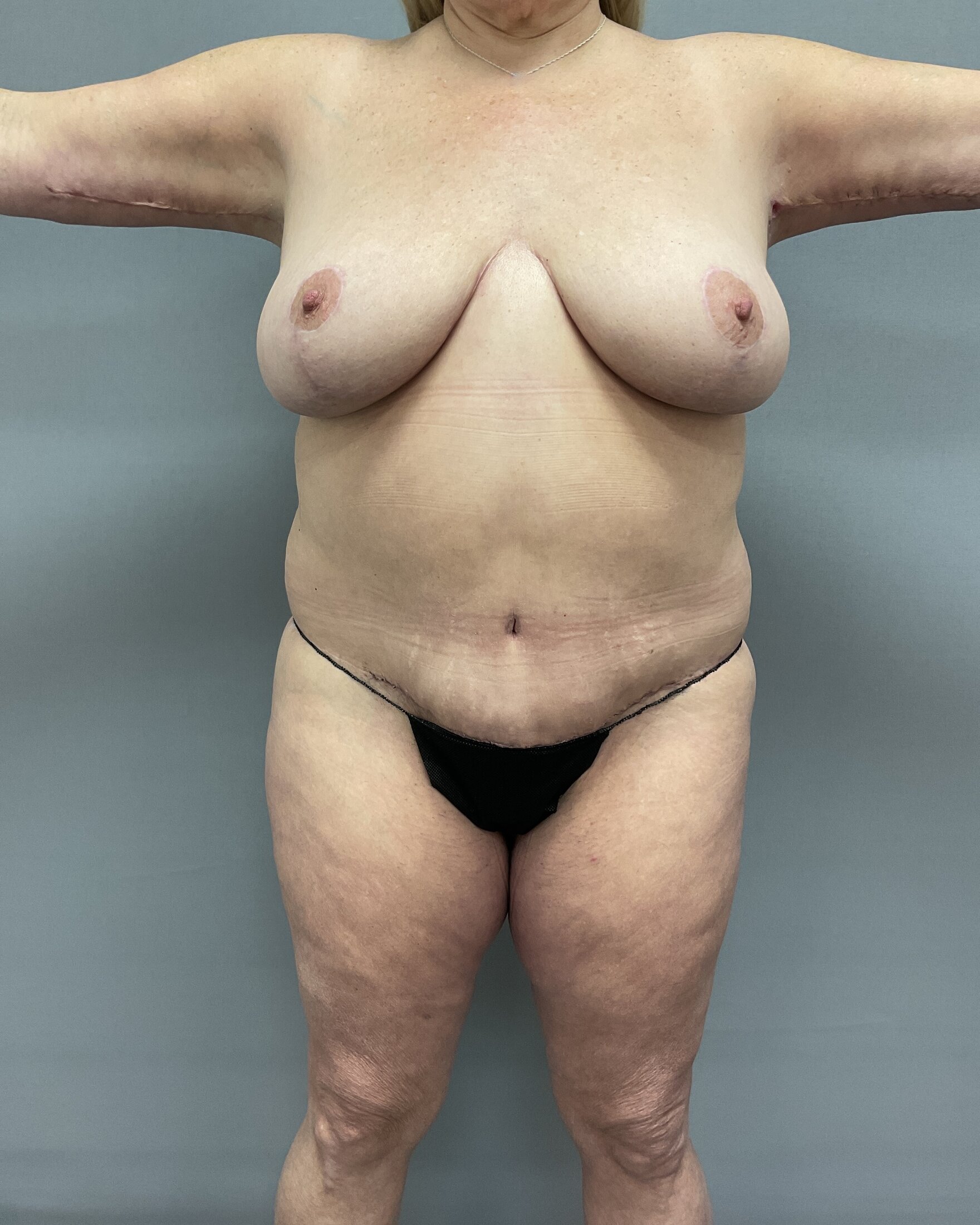 Body Lift Before & After Image