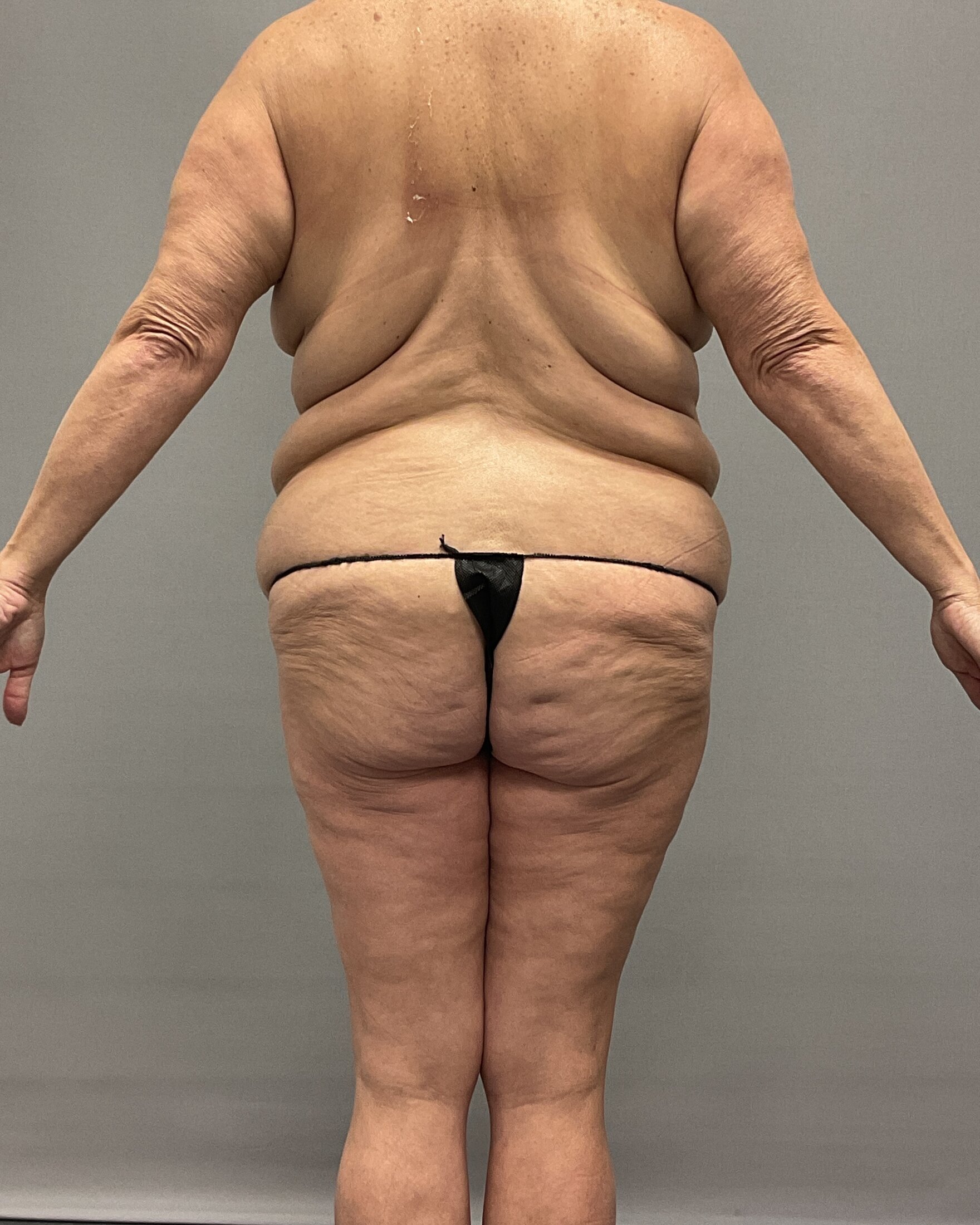 Body Lift Before & After Image