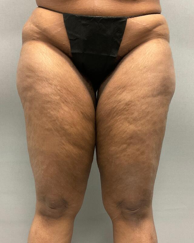 Liposuction Before & After Image