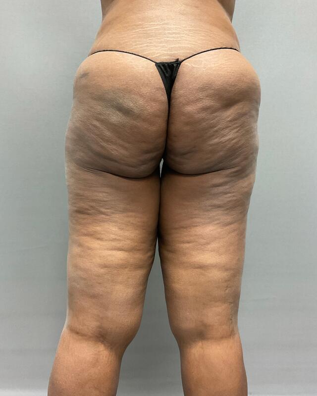 Liposuction Before & After Image