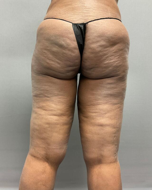 Liposuction Before & After Image