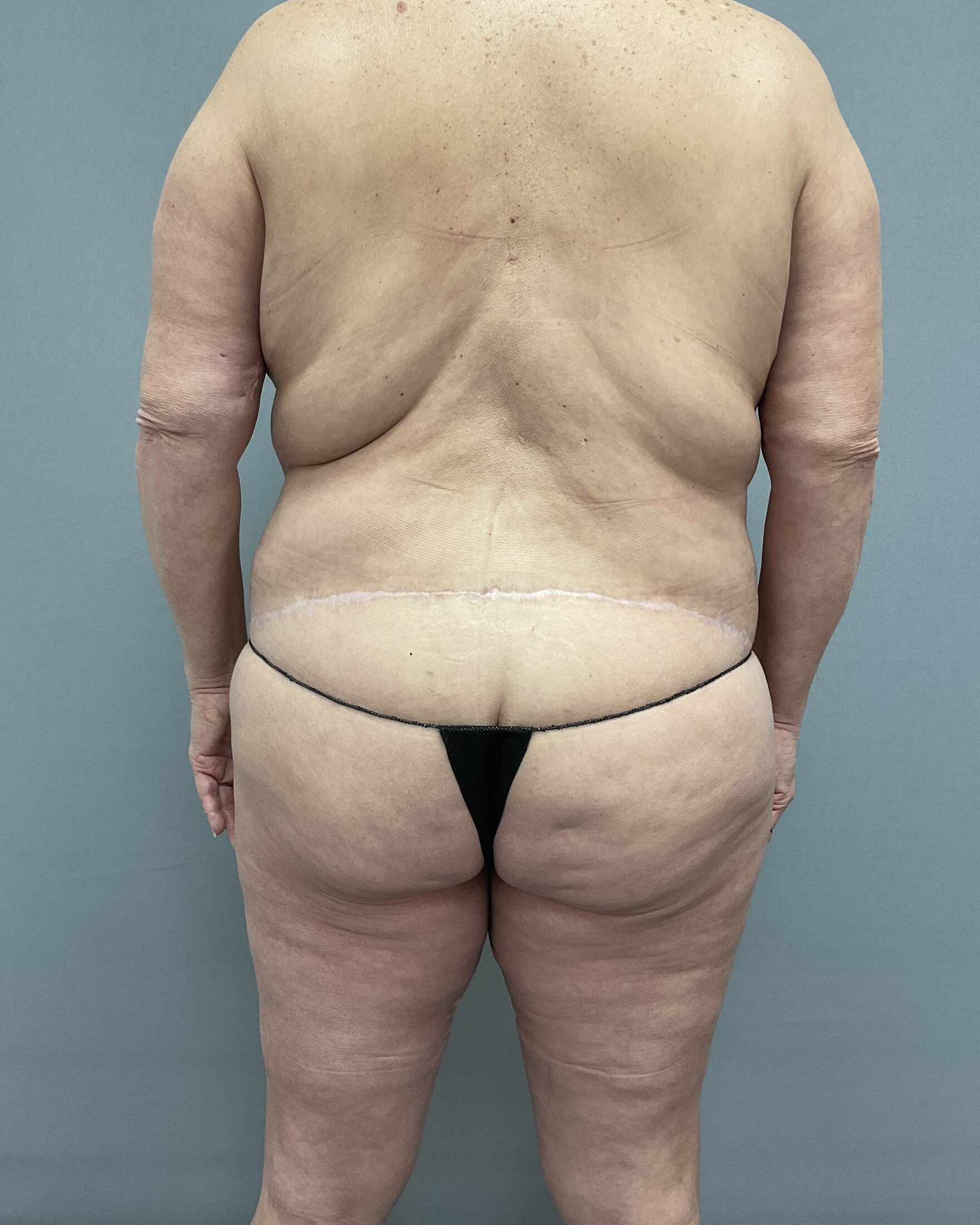 Liposuction Before & After Image