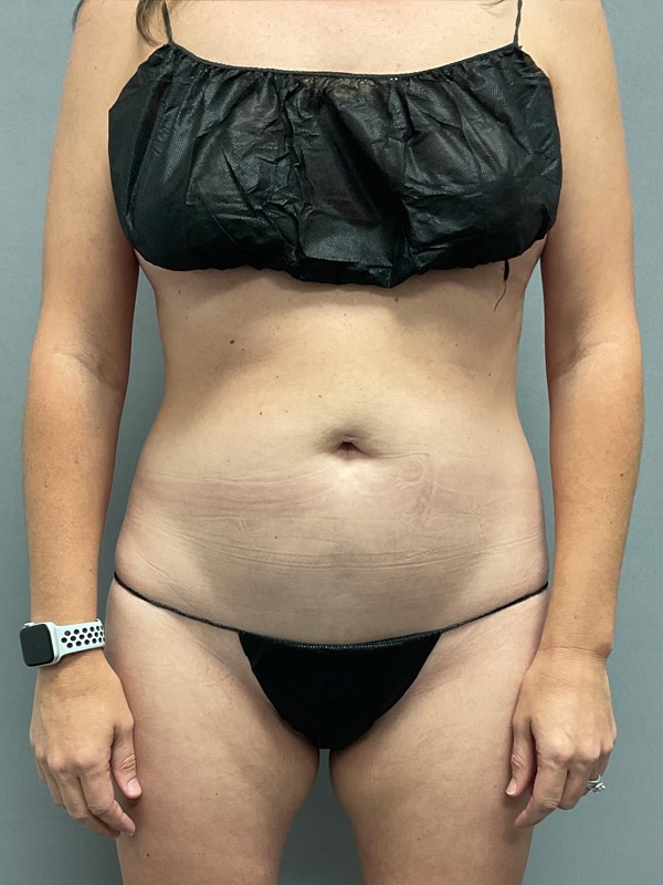 Liposuction Before & After Image