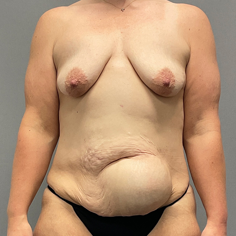 Tummy Tuck Before & After Image