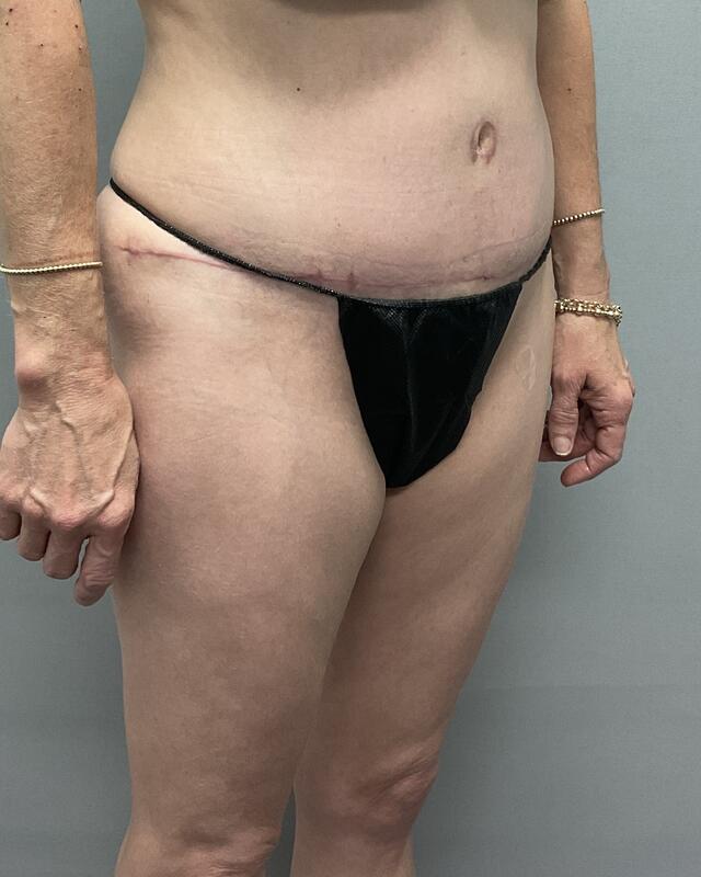 Tummy Tuck Before & After Image