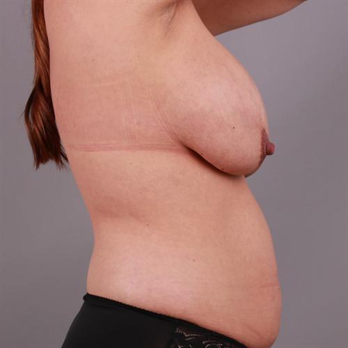 Breast Implant Exchange Before & After Image