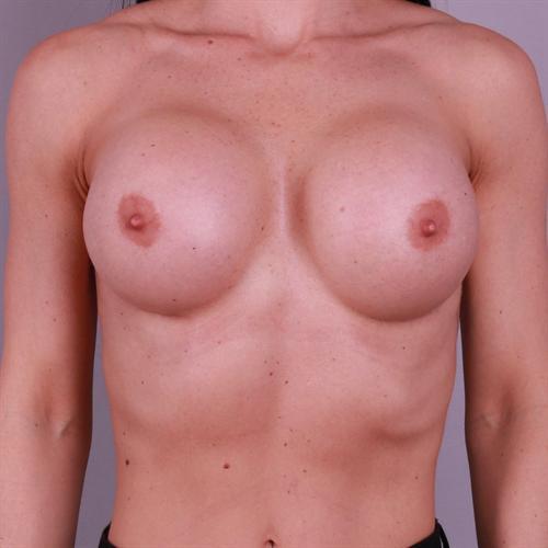 Breast Implant Exchange Before & After Image