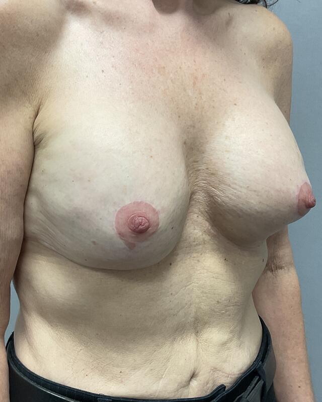 Breast Implant Exchange Before & After Image