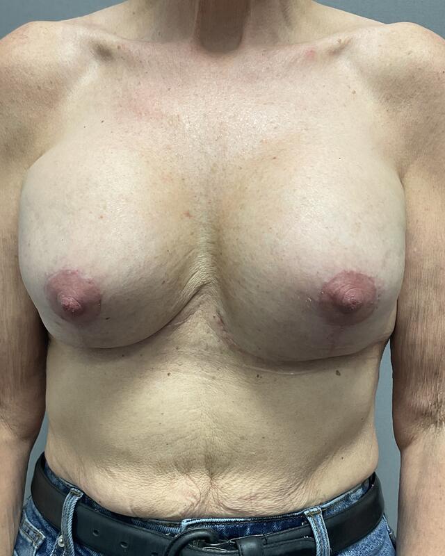 Breast Implant Exchange Before & After Image