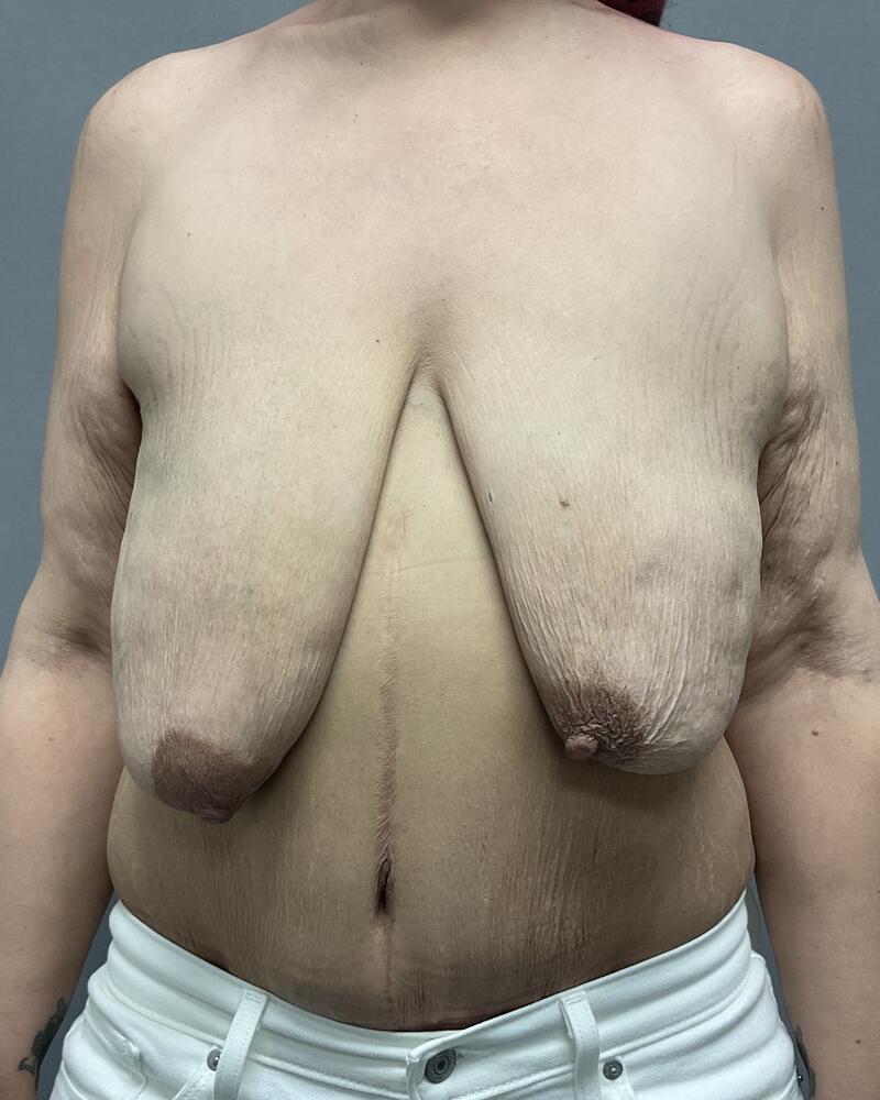 Breast Lift With Implants Before & After Image