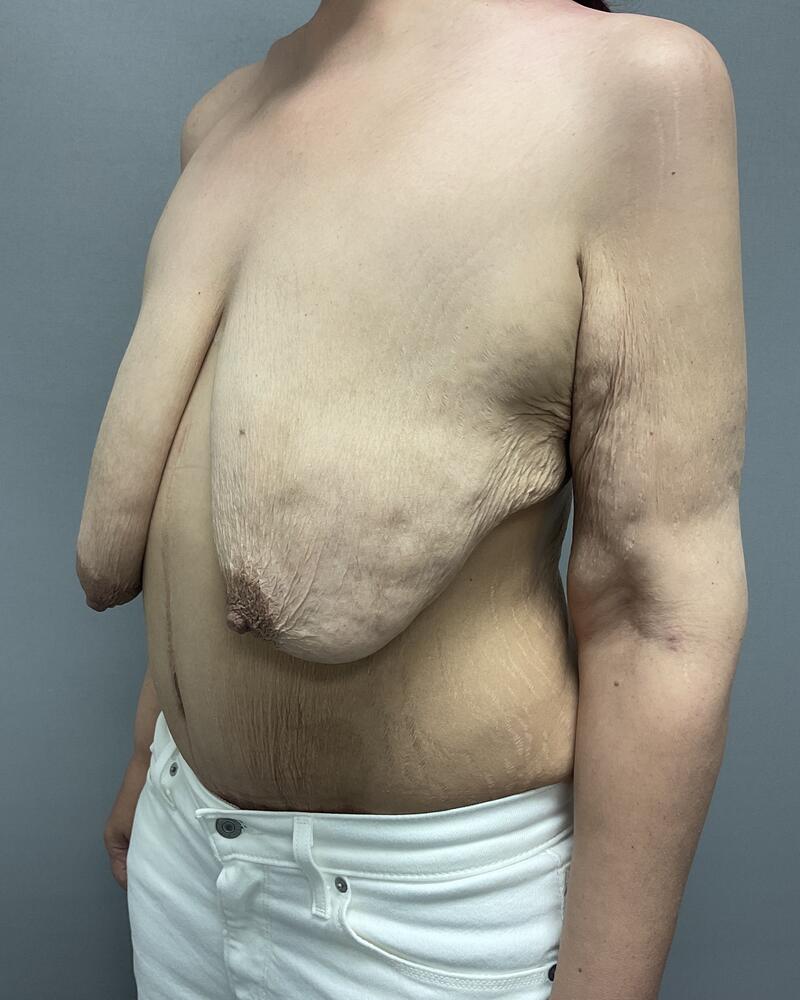 Breast Lift With Implants Before & After Image