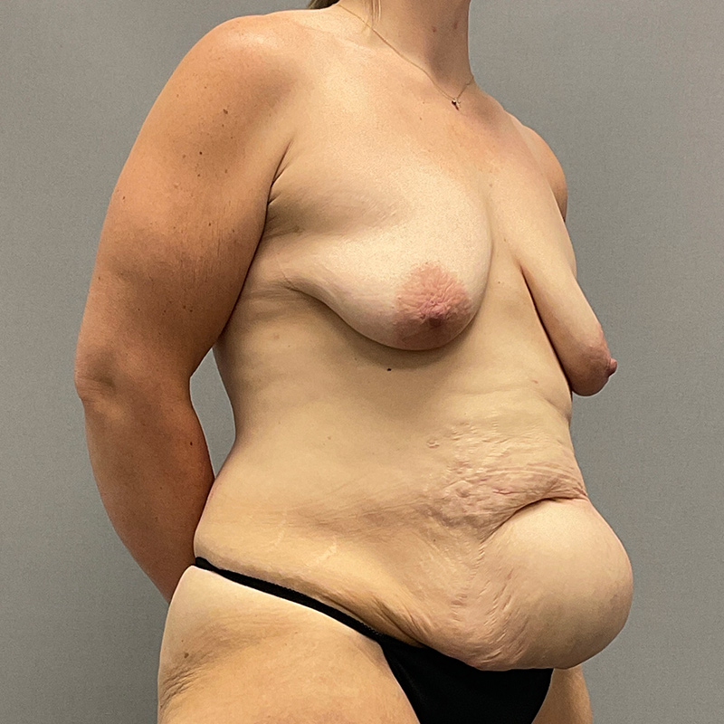 Breast Lift Before & After Image