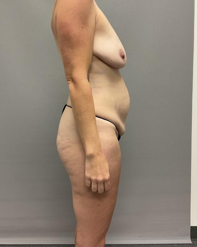 Breast Lift Before & After Image