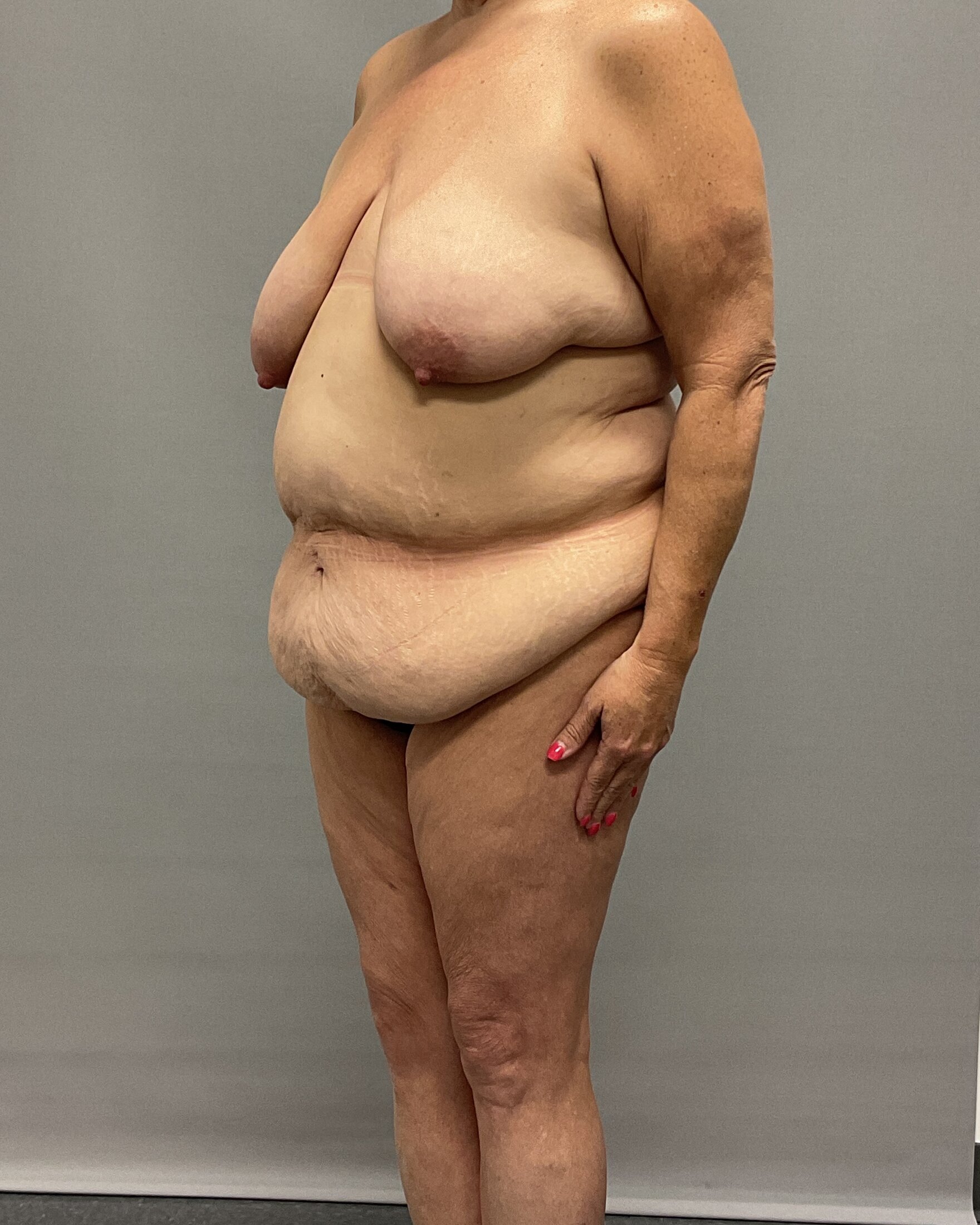 Breast Lift Before & After Image