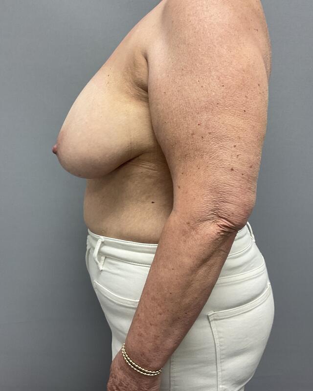 Breast Reconstruction Before & After Image