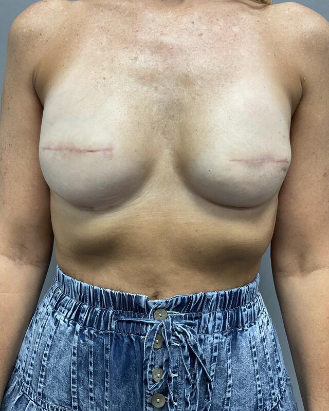 Breast Reconstruction Before & After Image