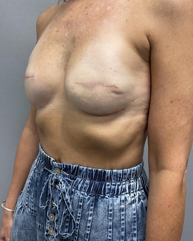 Breast Reconstruction Before & After Image