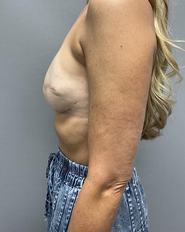 Breast Reconstruction Before & After Image