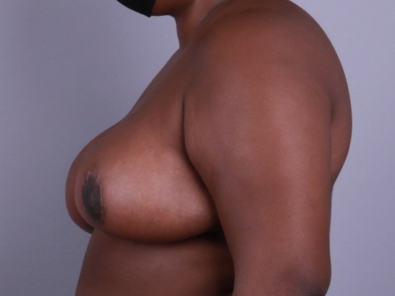 Breast Reduction Before & After Image