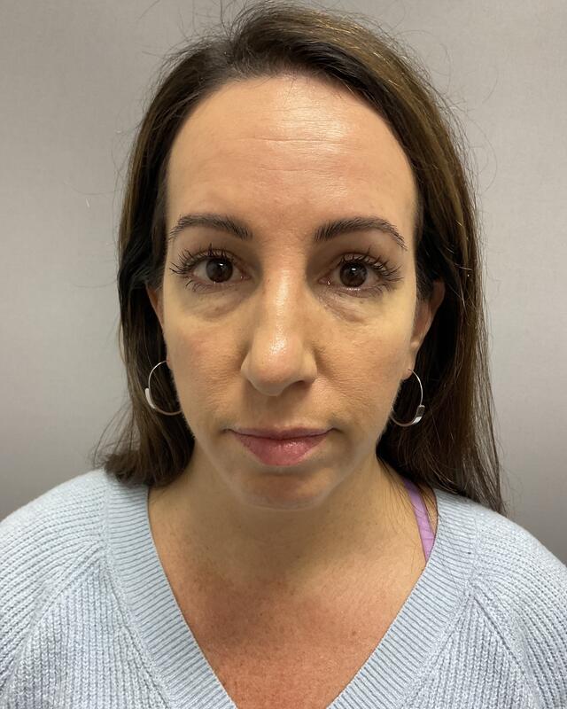 Blepharoplasty Before & After Image