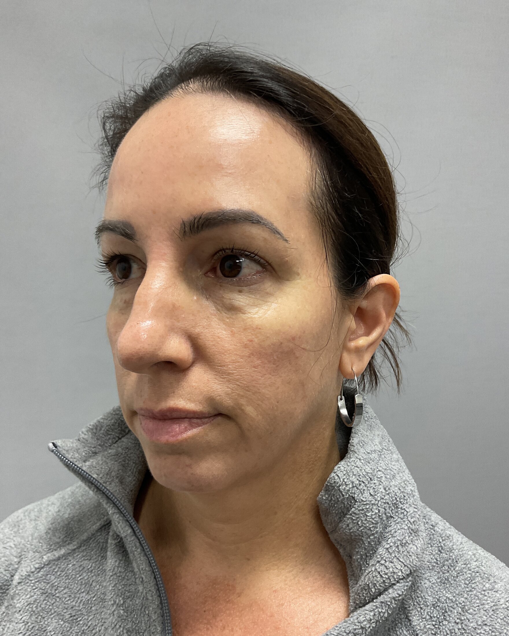 Blepharoplasty Before & After Image