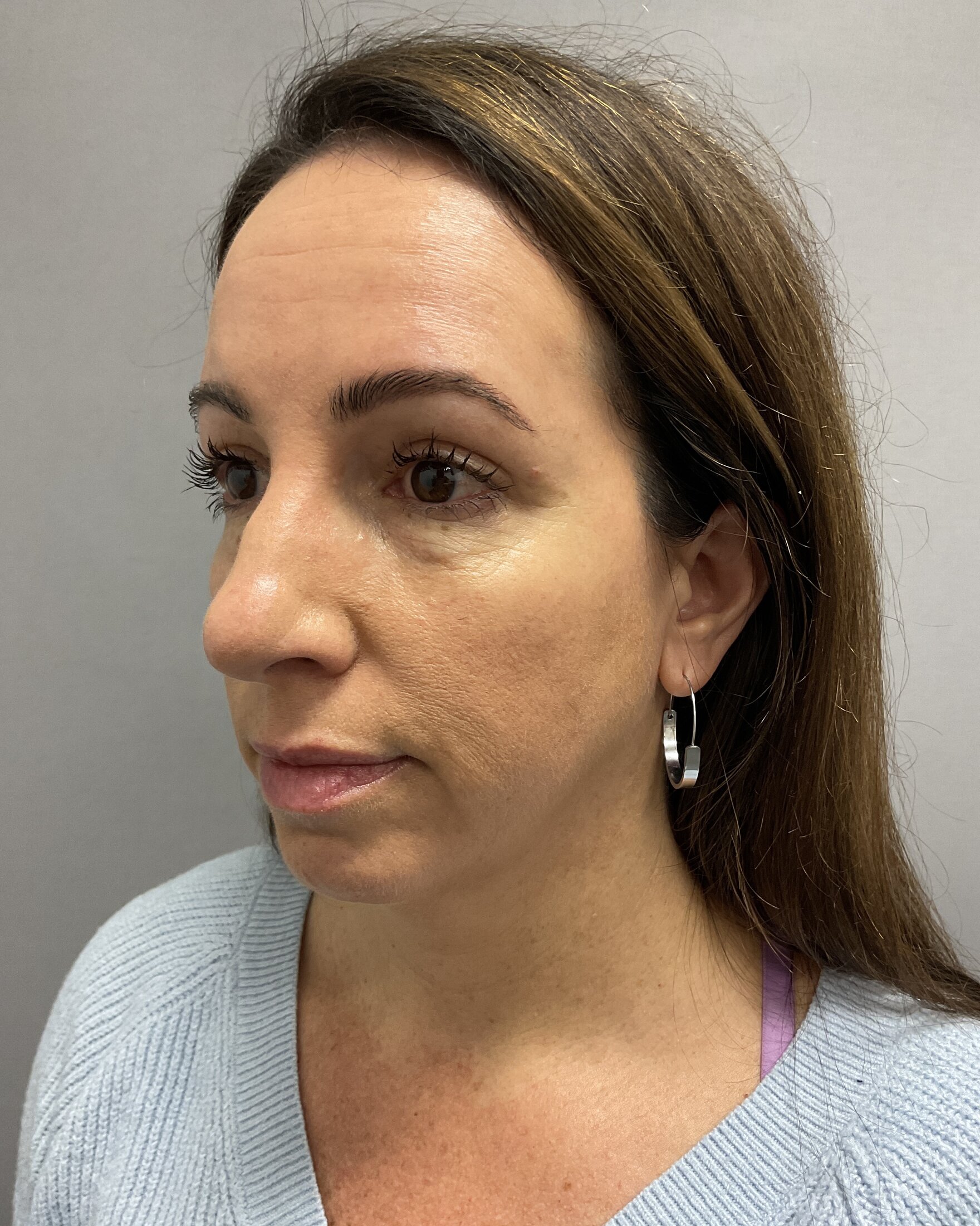 Blepharoplasty Before & After Image