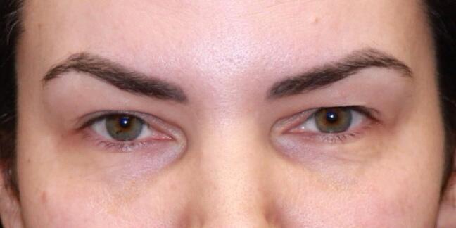 Blepharoplasty Before & After Image