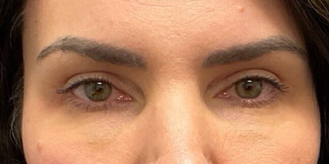 Blepharoplasty Before & After Image