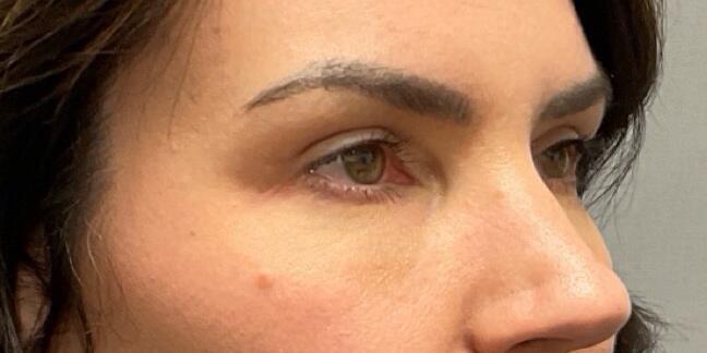 Blepharoplasty Before & After Image