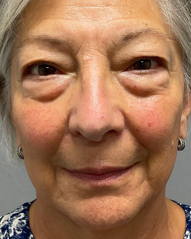 Blepharoplasty Before & After Image