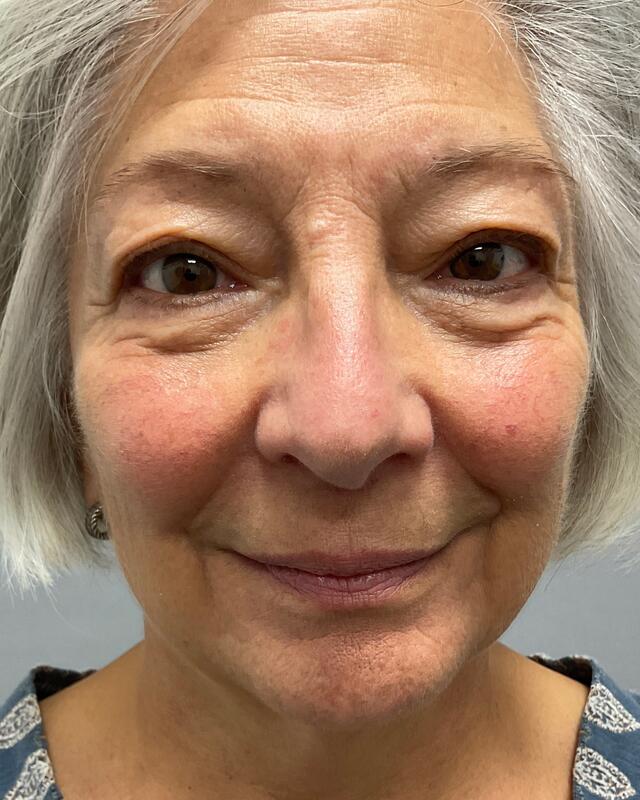 Blepharoplasty Before & After Image