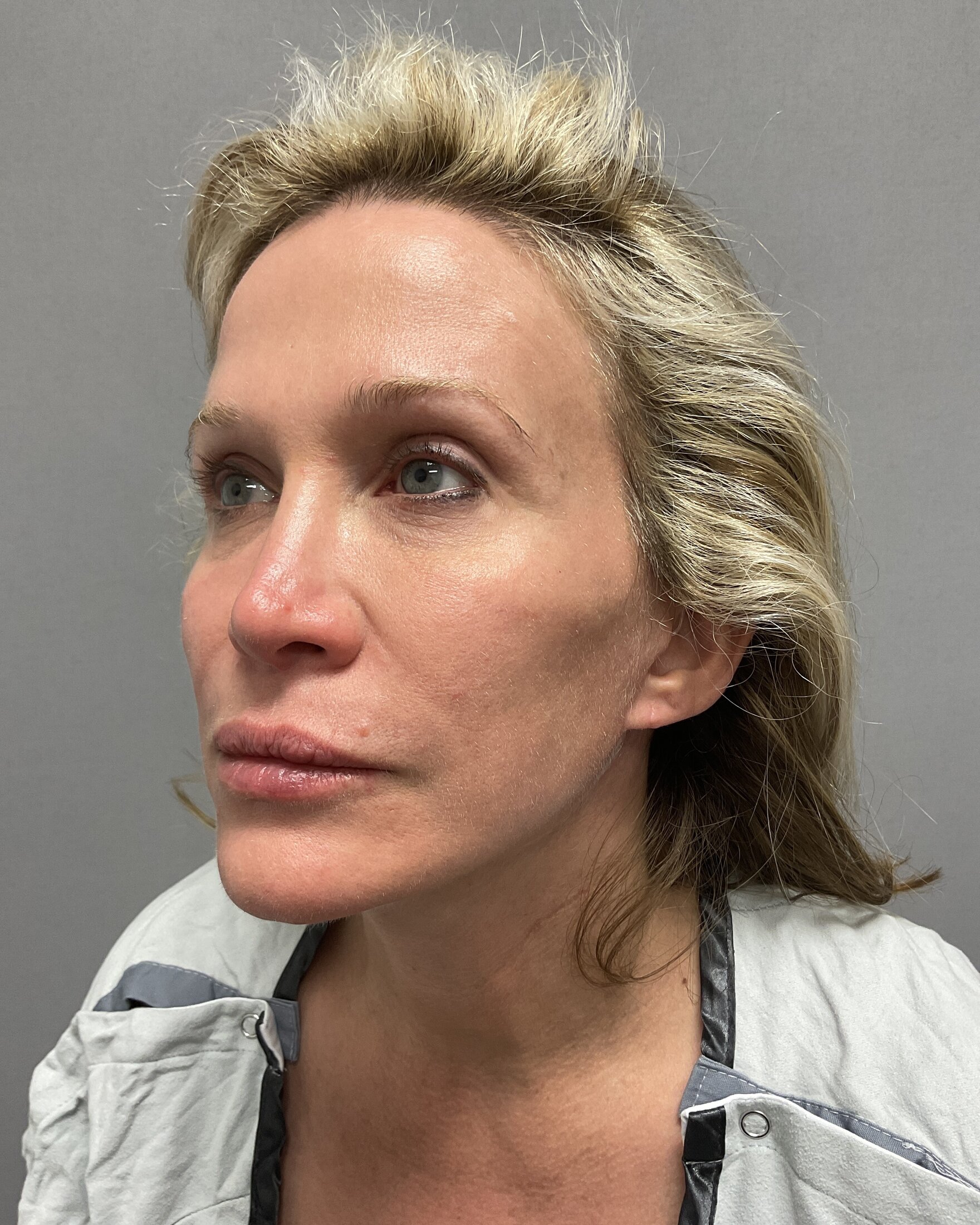 Blepharoplasty Before & After Image