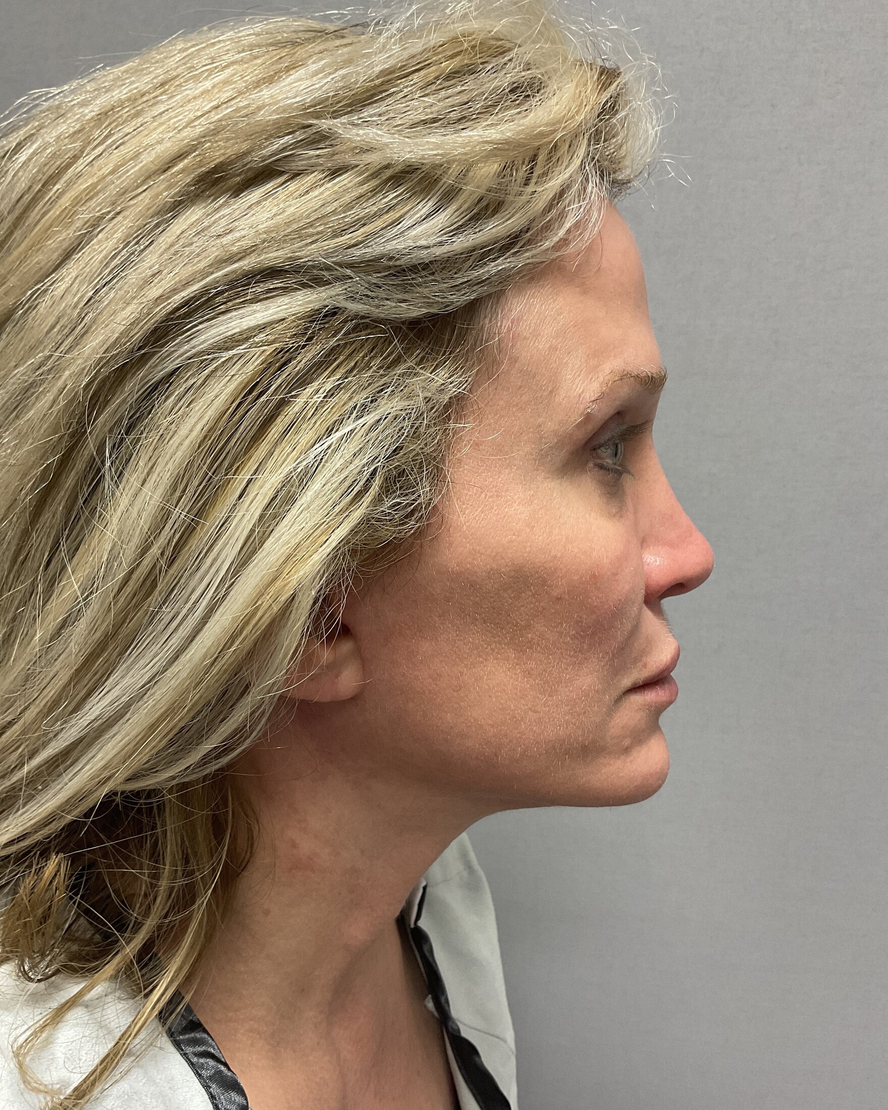 Blepharoplasty Before & After Image