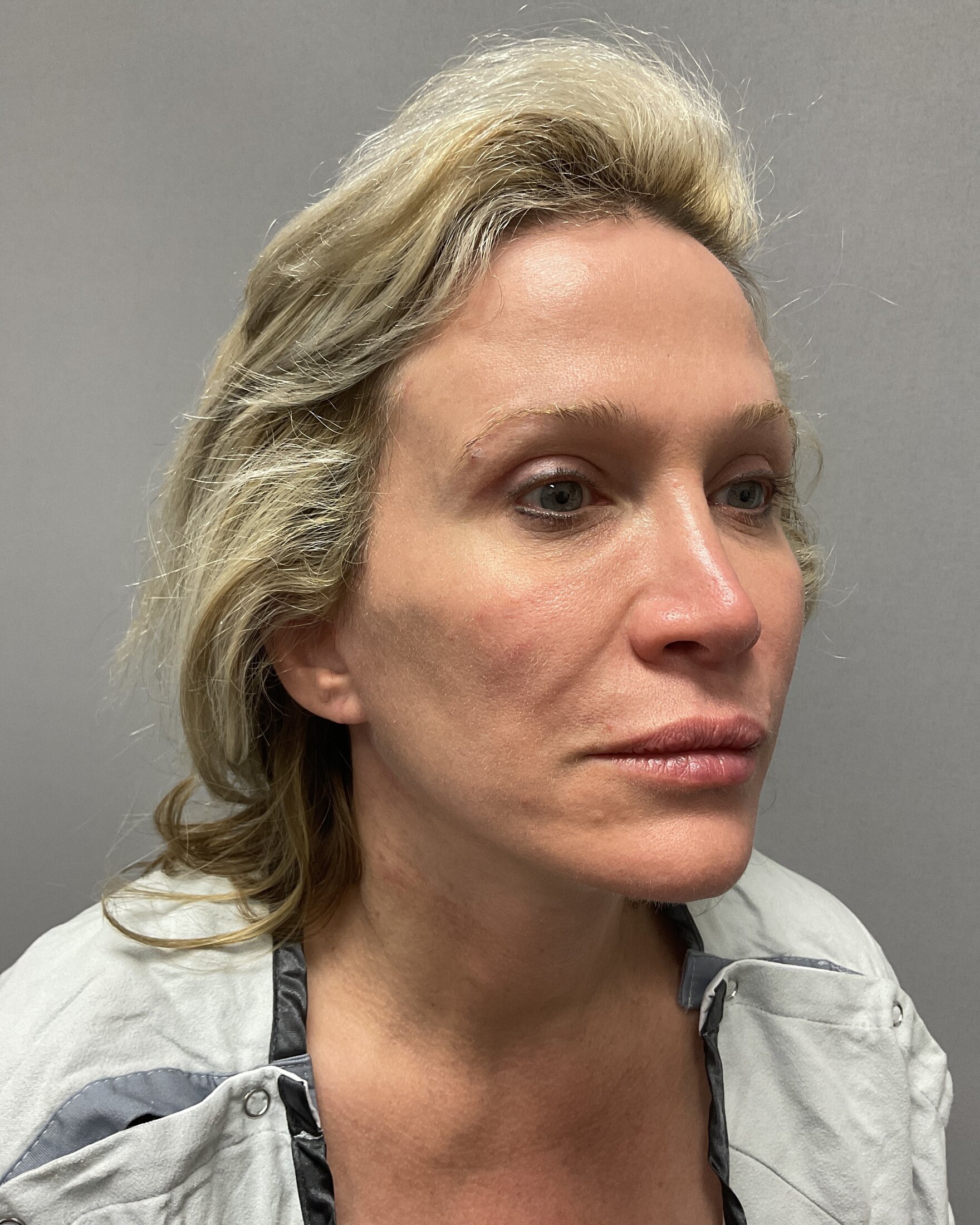 Blepharoplasty Before & After Image