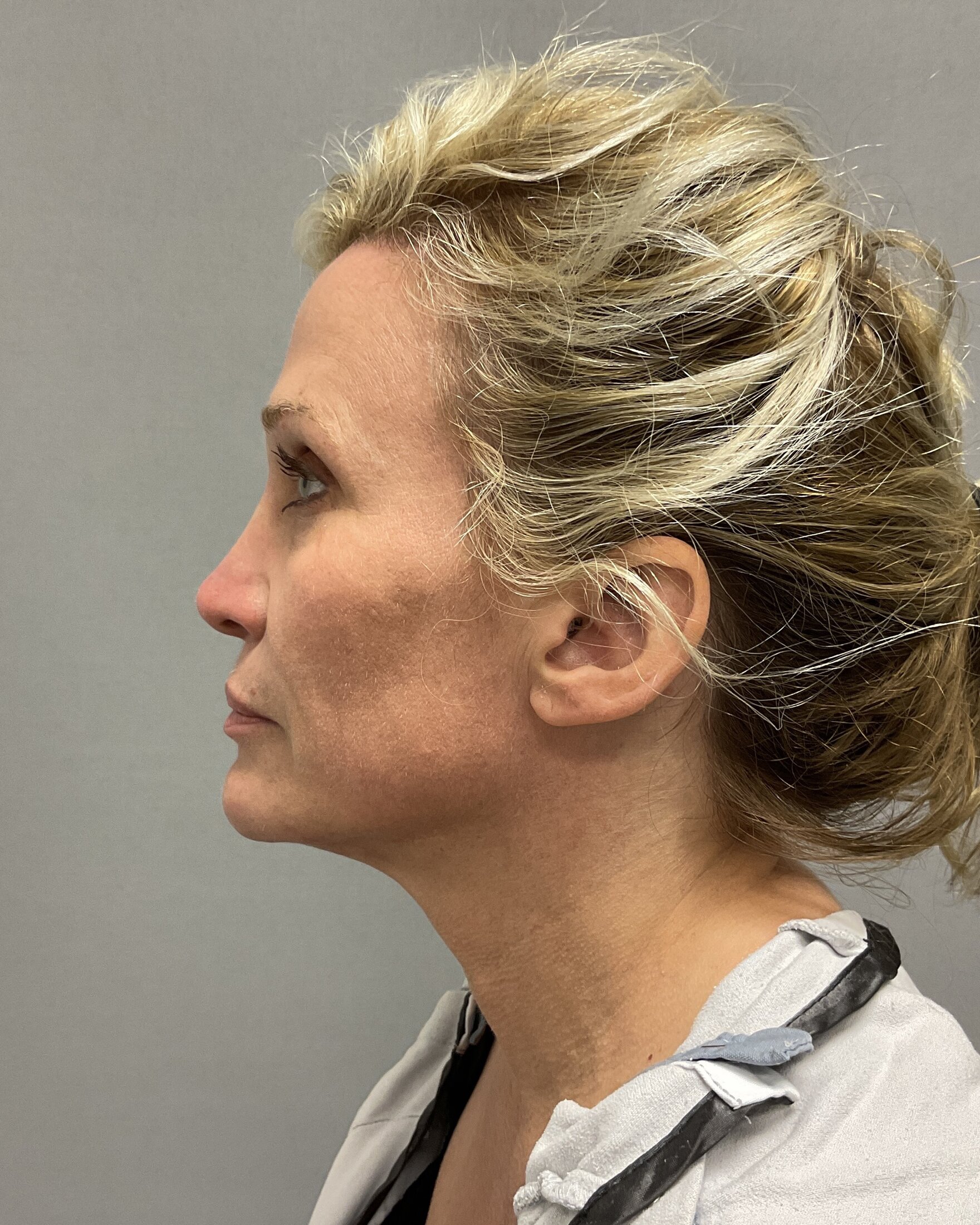 Facelift Before & After Image