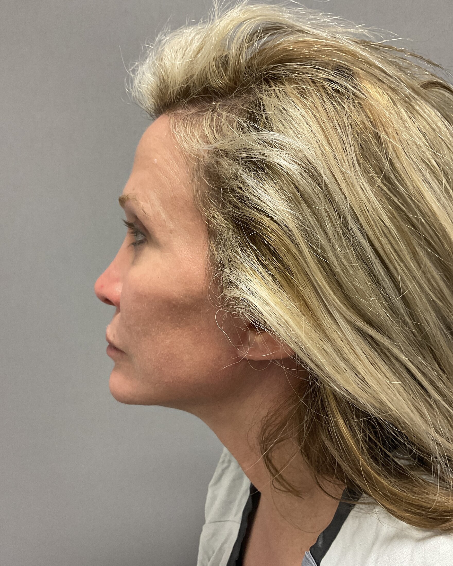 Facelift Before & After Image