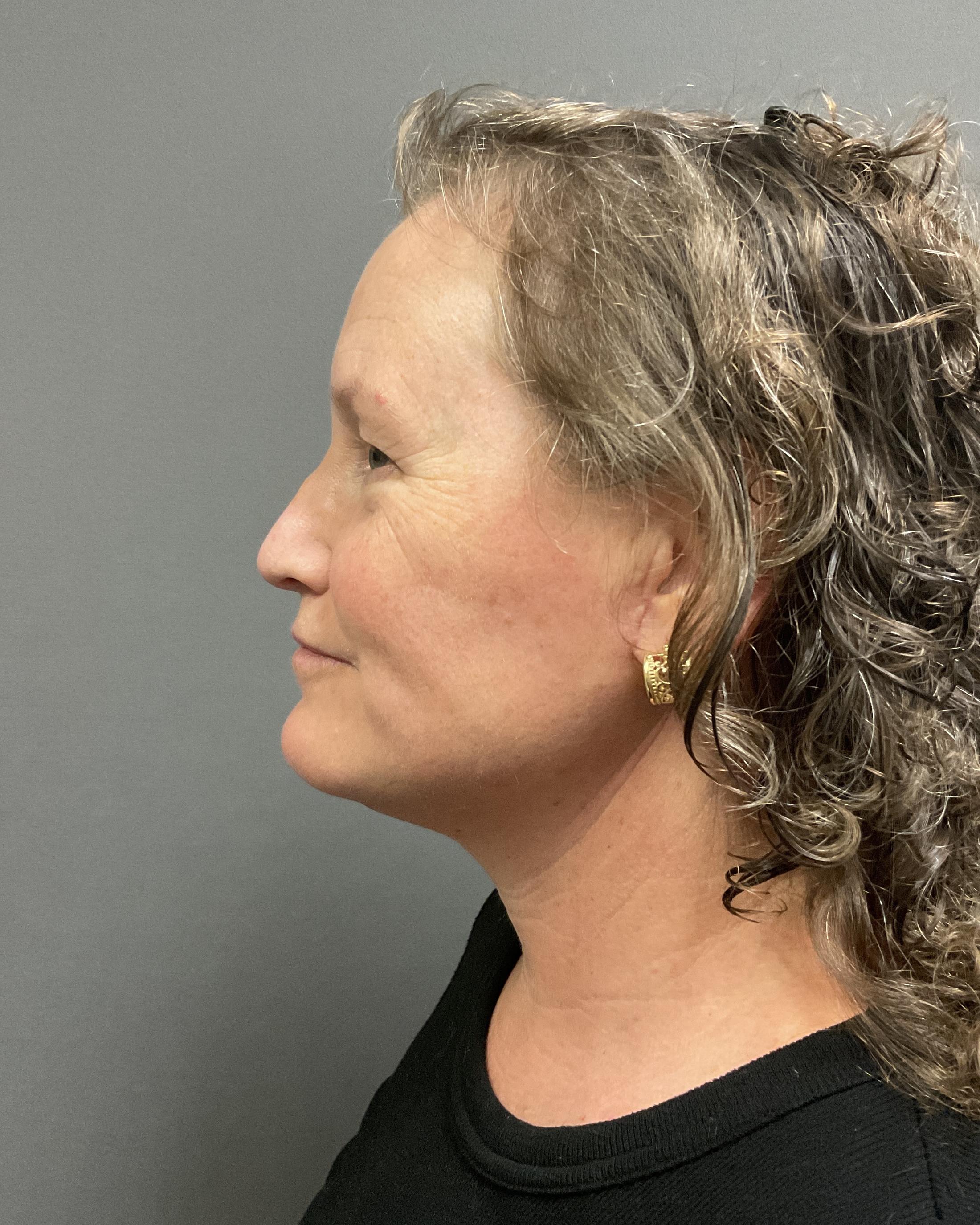 Facelift Before & After Image