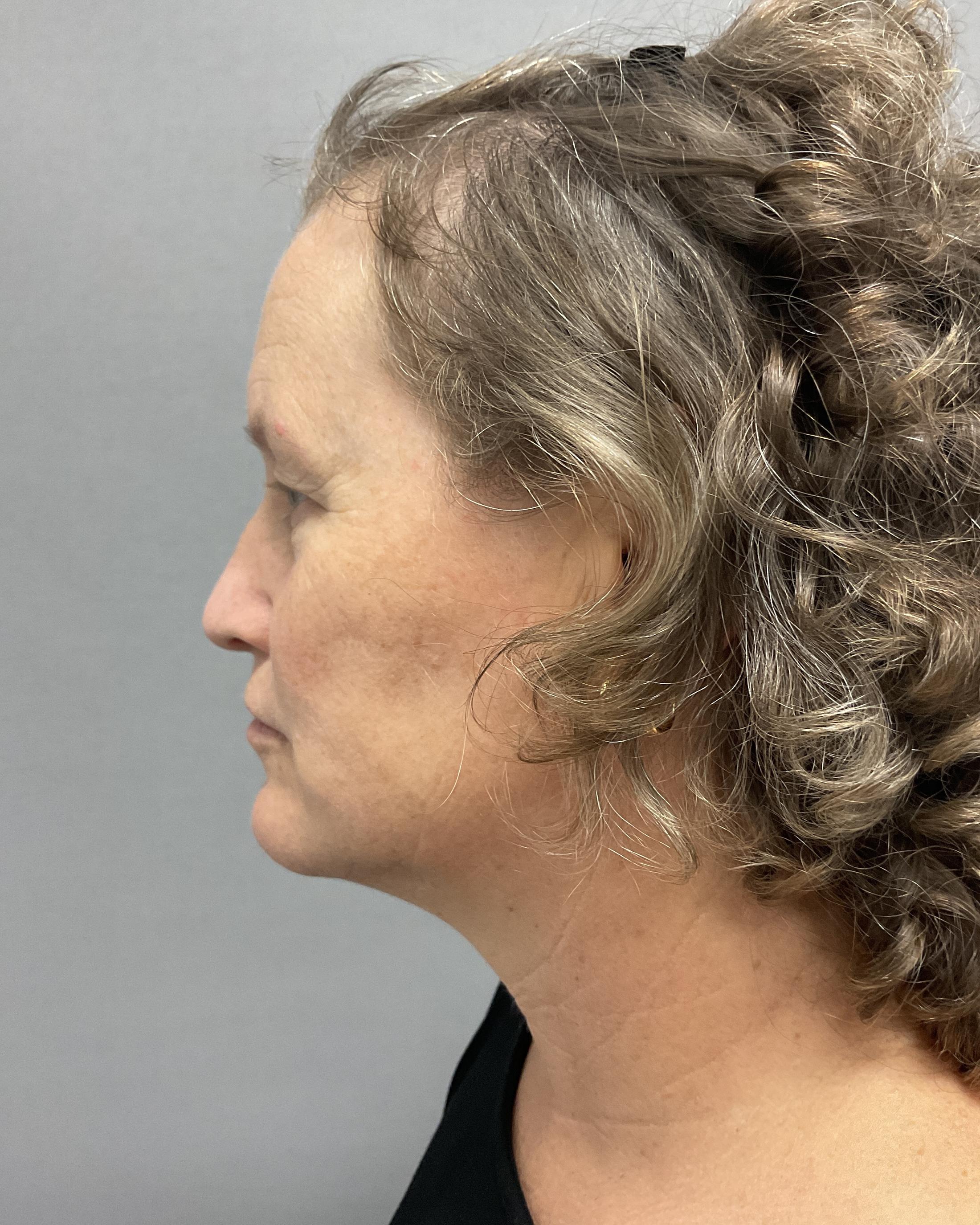 Facelift Before & After Image