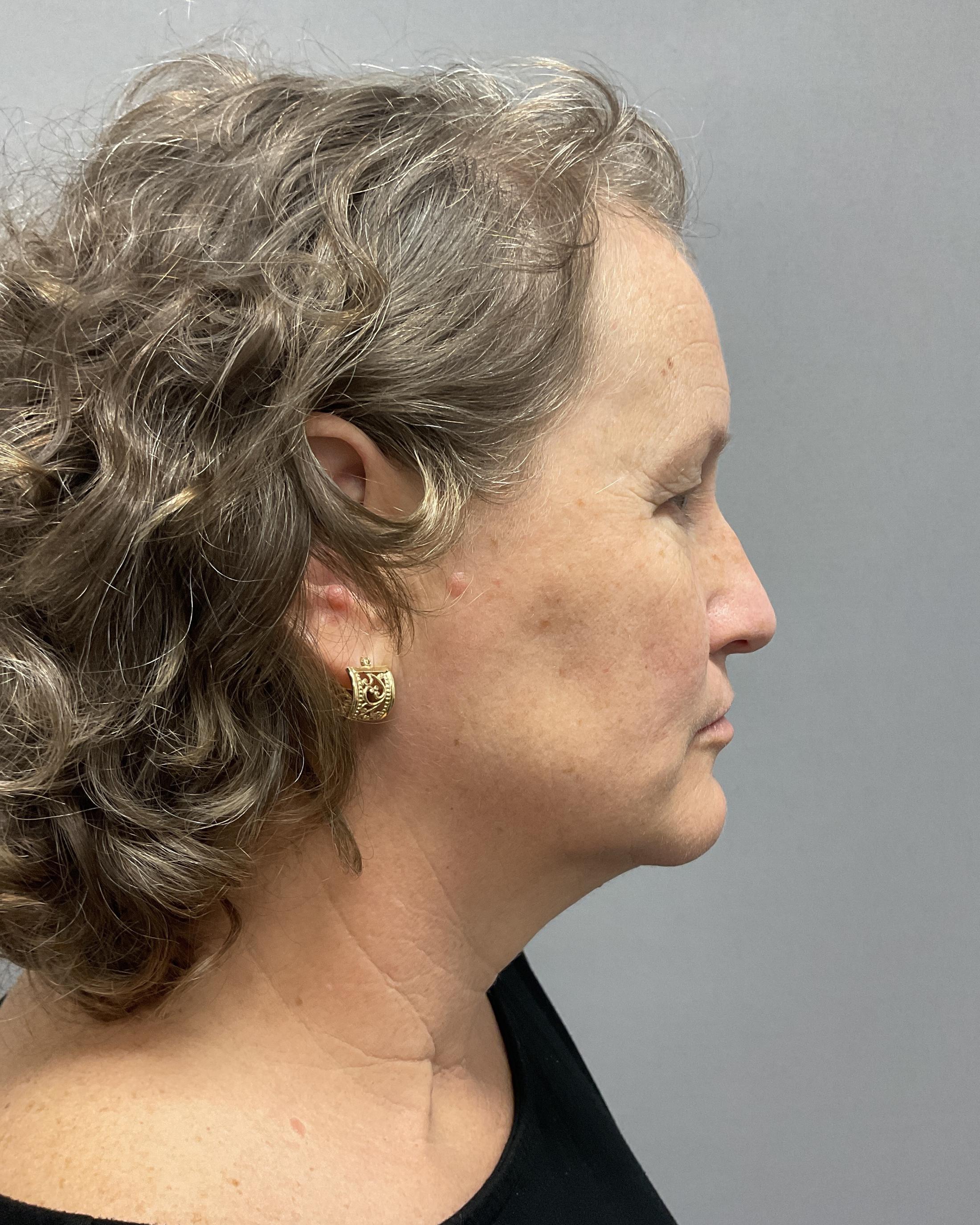 Facelift Before & After Image