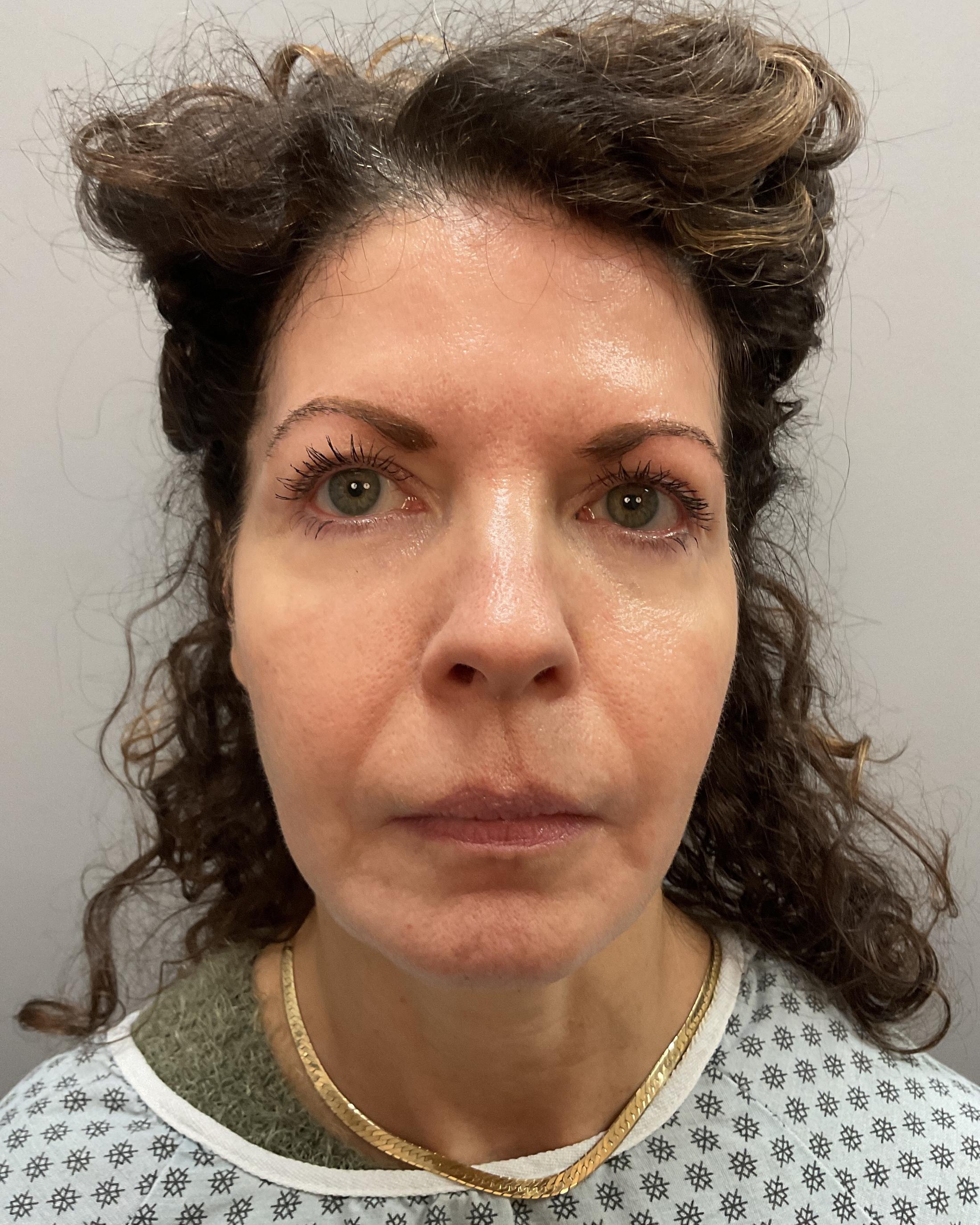 Facelift Before & After Image