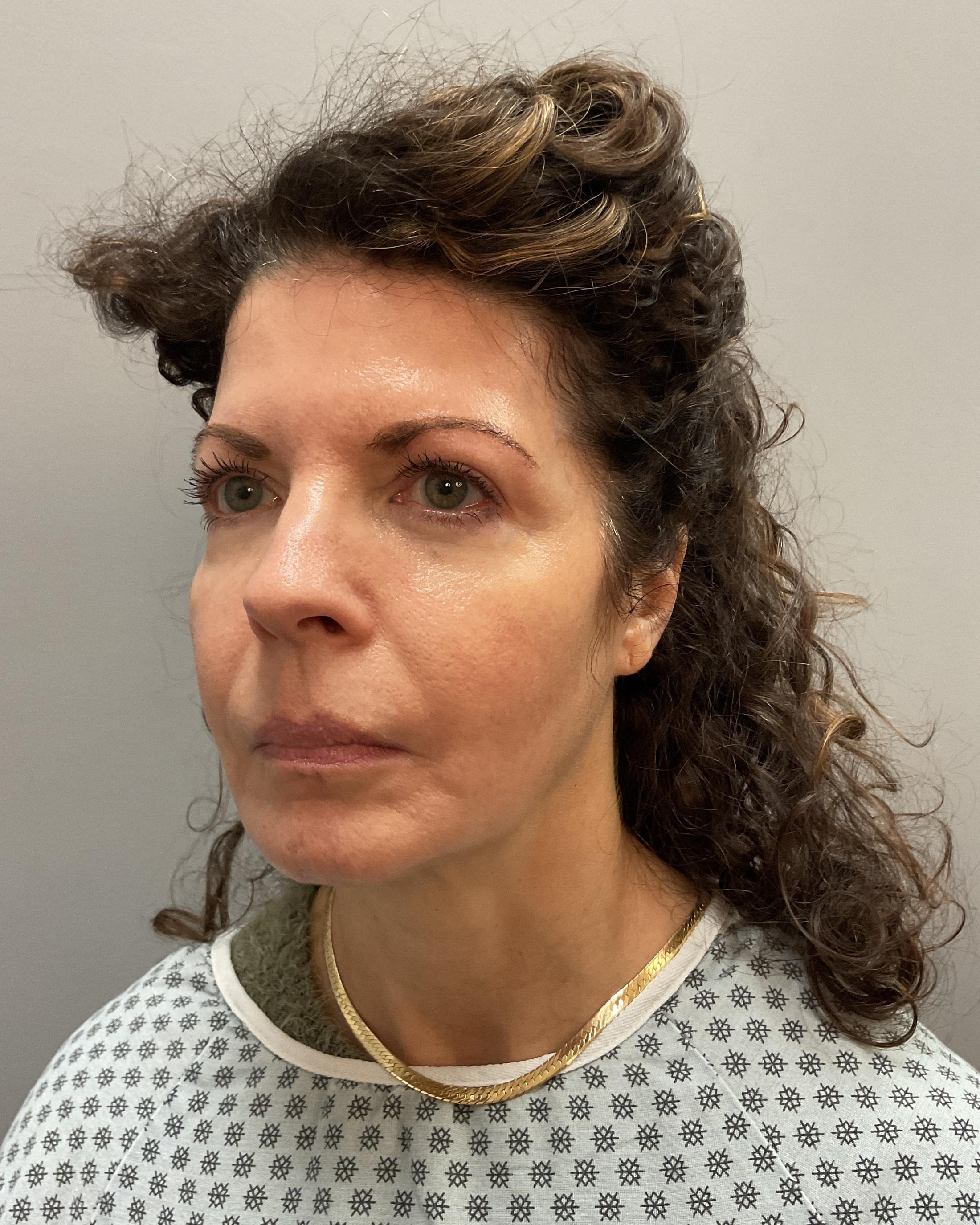 Facelift Before & After Image