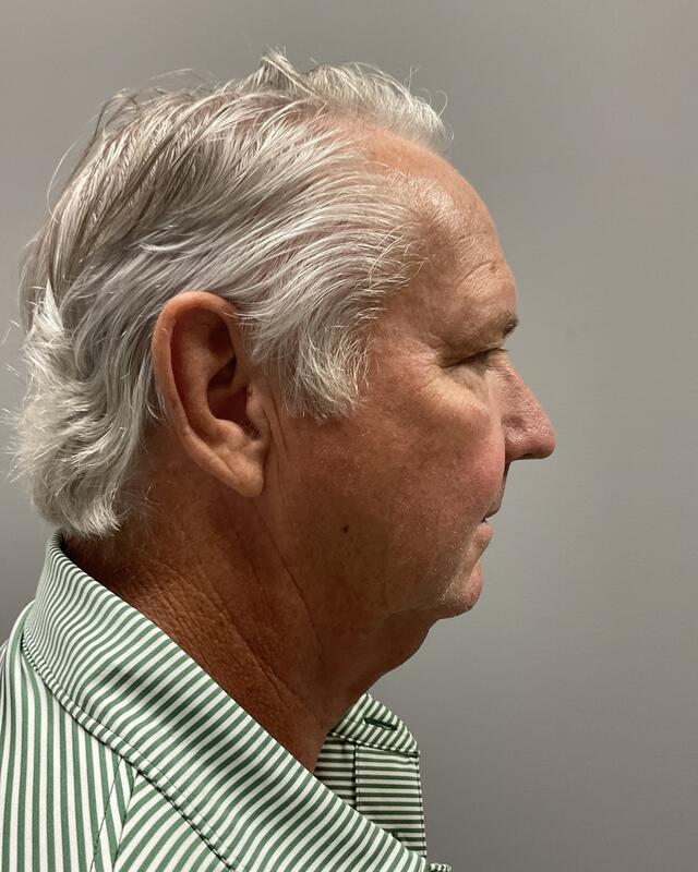 Neck Lift Before & After Image