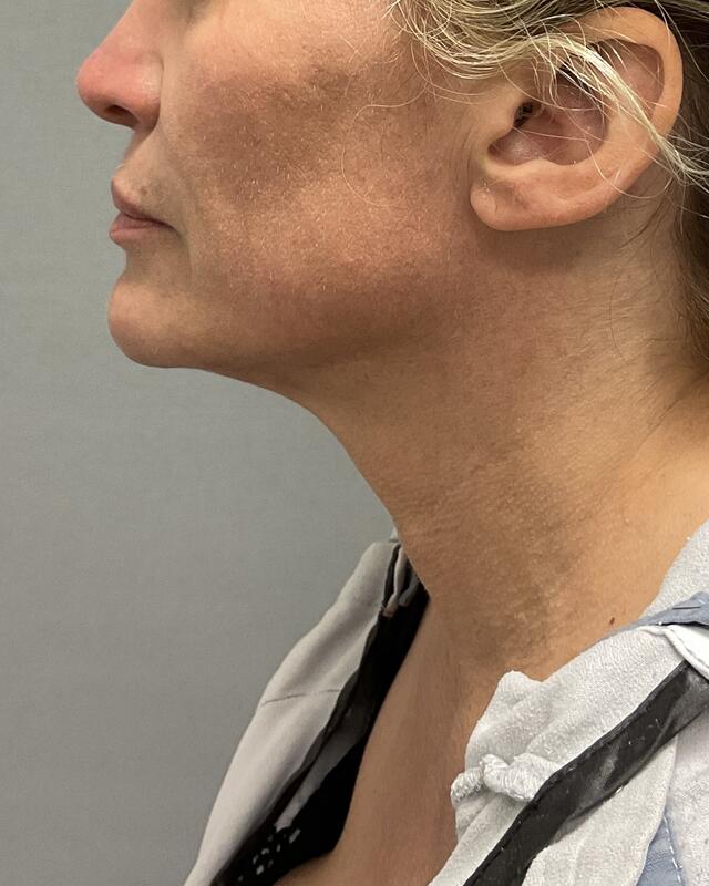 Neck Lift Before & After Image