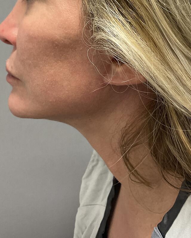 Neck Lift Before & After Image