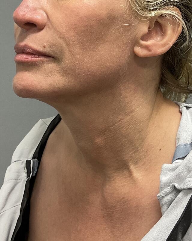 Neck Lift Before & After Image